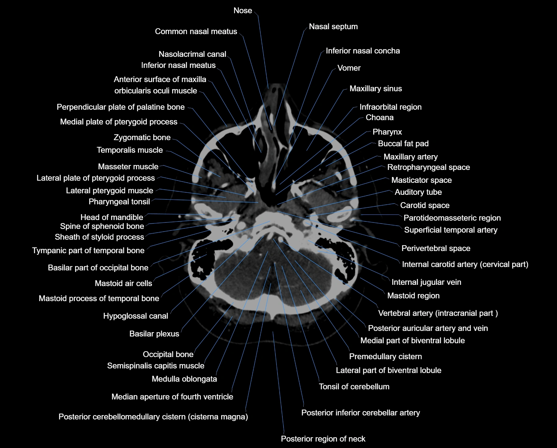 CT scan brain axial labelled cross sectional anatomy image-img-00008.webp